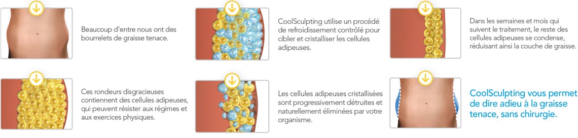 Cryolipolyse