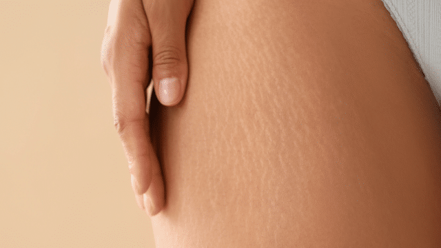 Vergetures et cicatrices : quelles options dermatologiques pour améliorer la peau ?